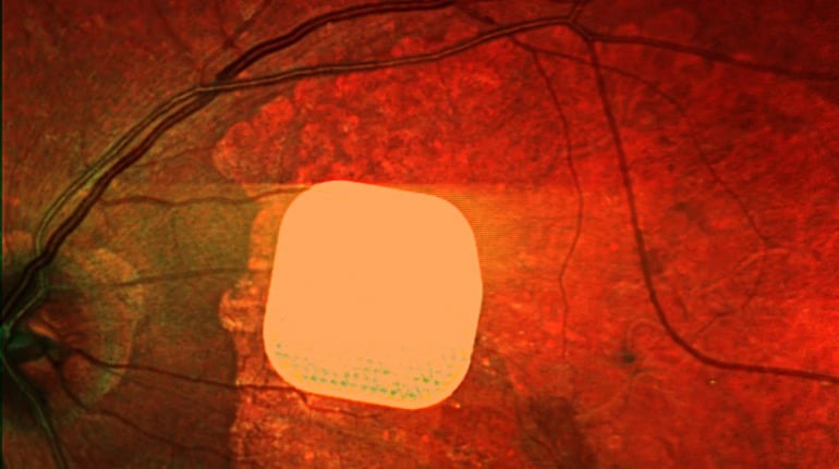 Британські лікарі частково повернули зір пацієнтам за допомогою мікрочипа